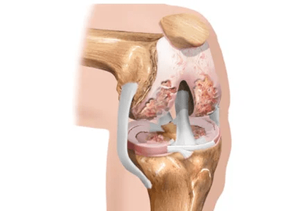 Arthrose oder Arthritis von Unterschieden