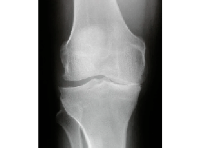 Diagnose der Arthrose des Kniegelenks