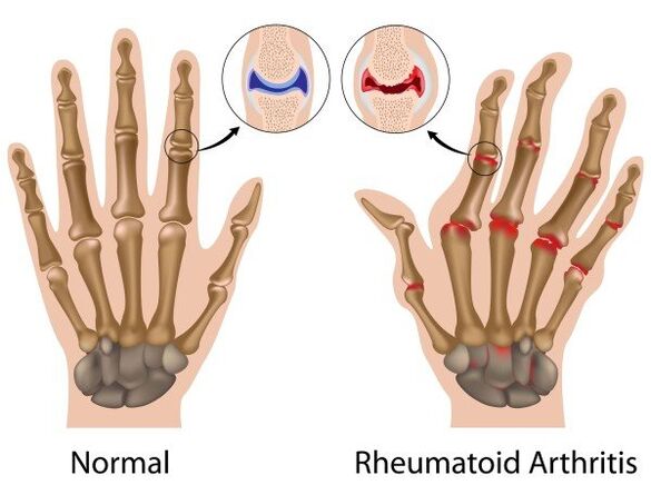 Fingergelenke ohne Pathologie und mit rheumatoider Arthritis
