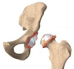 Die Gründe für die Entwicklung der Arthrose des Hüftgelenks