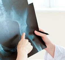 wie man Arthrose des Hüftgelenks behandelt