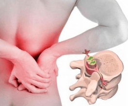 Lumbago zu Beginn der Krankheit Osteochondrose