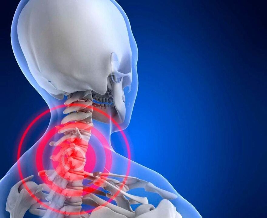 Nackenschmerzen mit zervikaler Osteochondrose