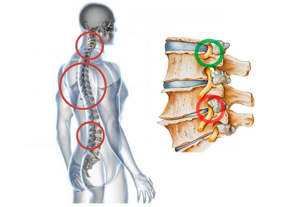 Wie sieht die zervikale Osteochondrose der Wirbel aus