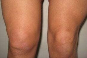 Entzündung im Kniegelenk mit Arthritis und Arthrose
