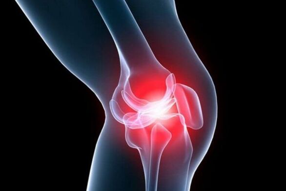 Arthrose des Kniegelenks